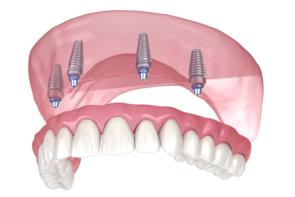 What Are Dental Implants? Do They really worth it?