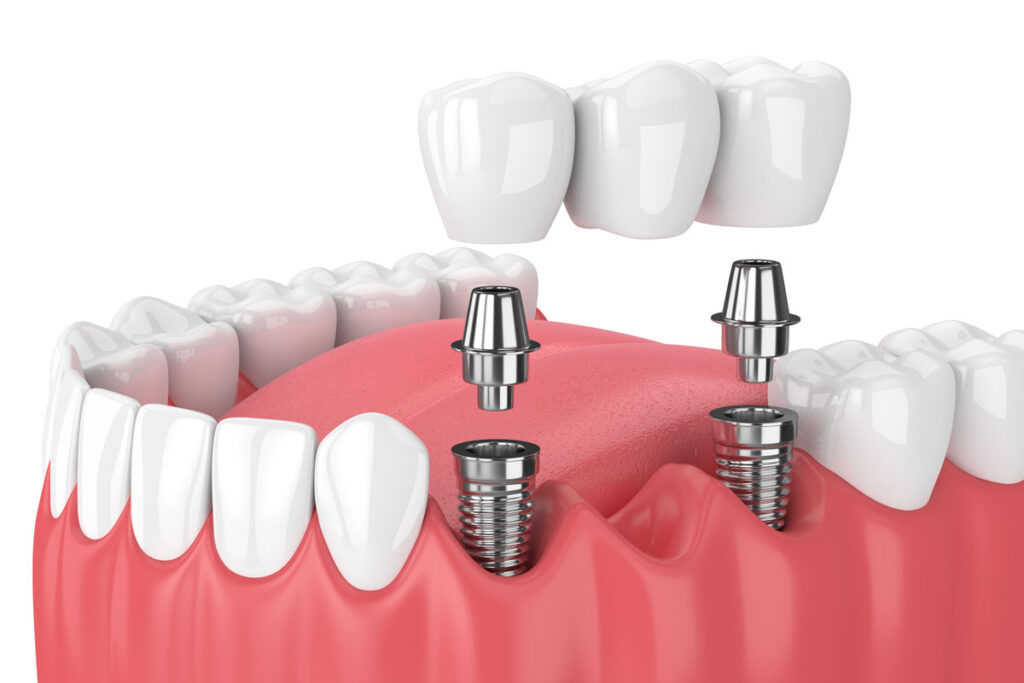 What Are Dental Implants? Do They really worth it?