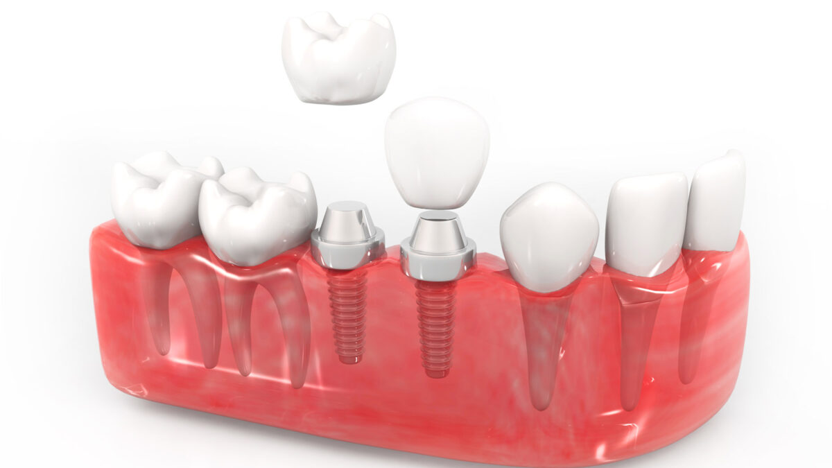 3D demonstration of Dental Implants at Aria Dental