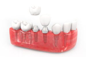 3D demonstration of Dental Implants at Aria Dental