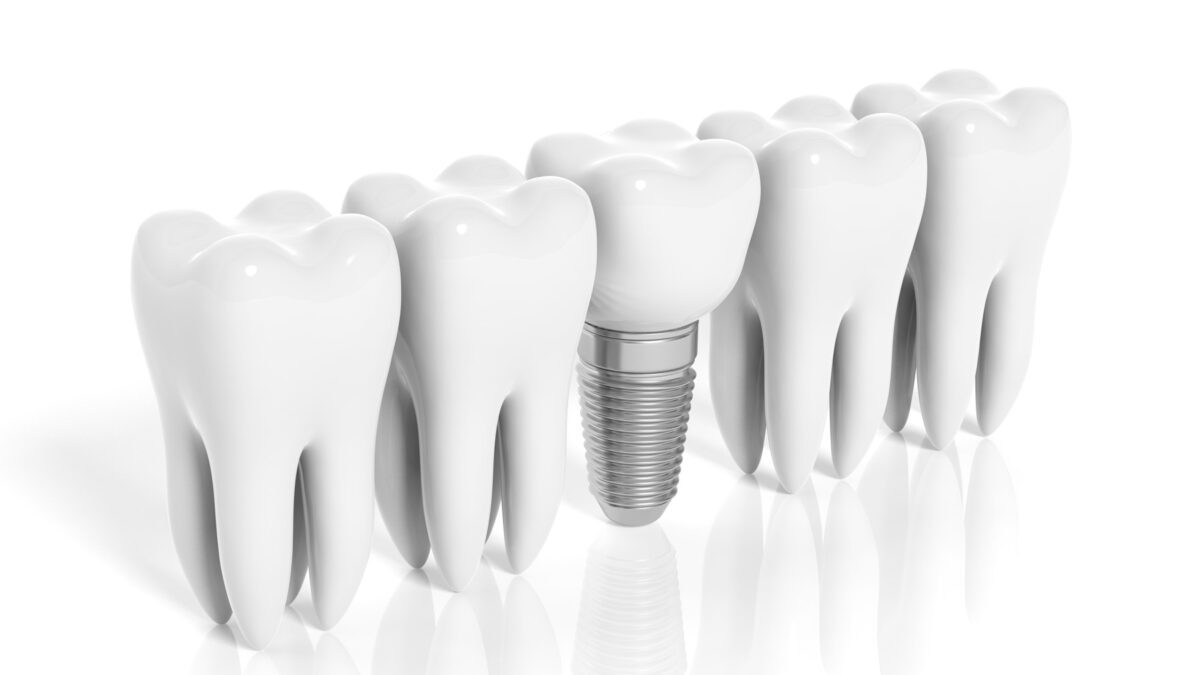 3D illustration of dental implant between natural teeth