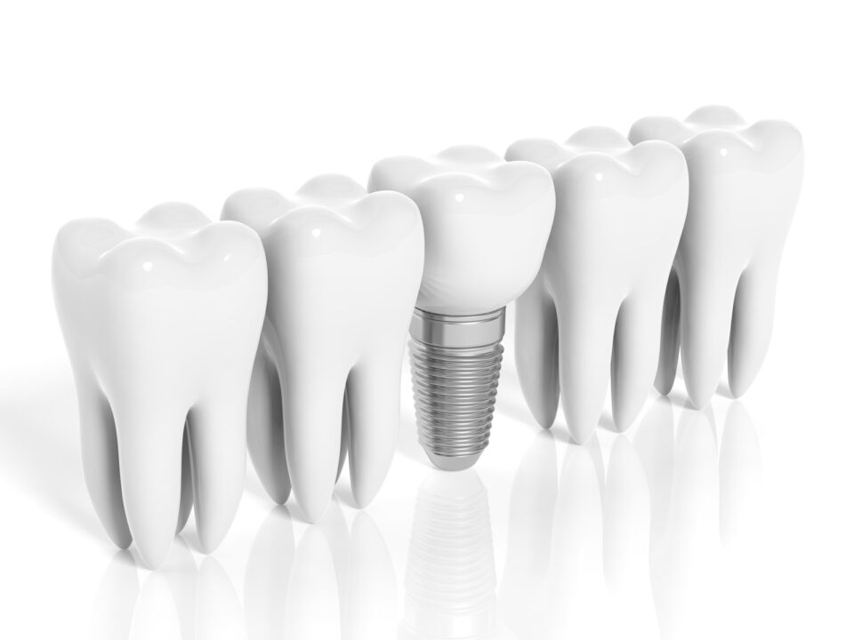 3D illustration of dental implant between natural teeth