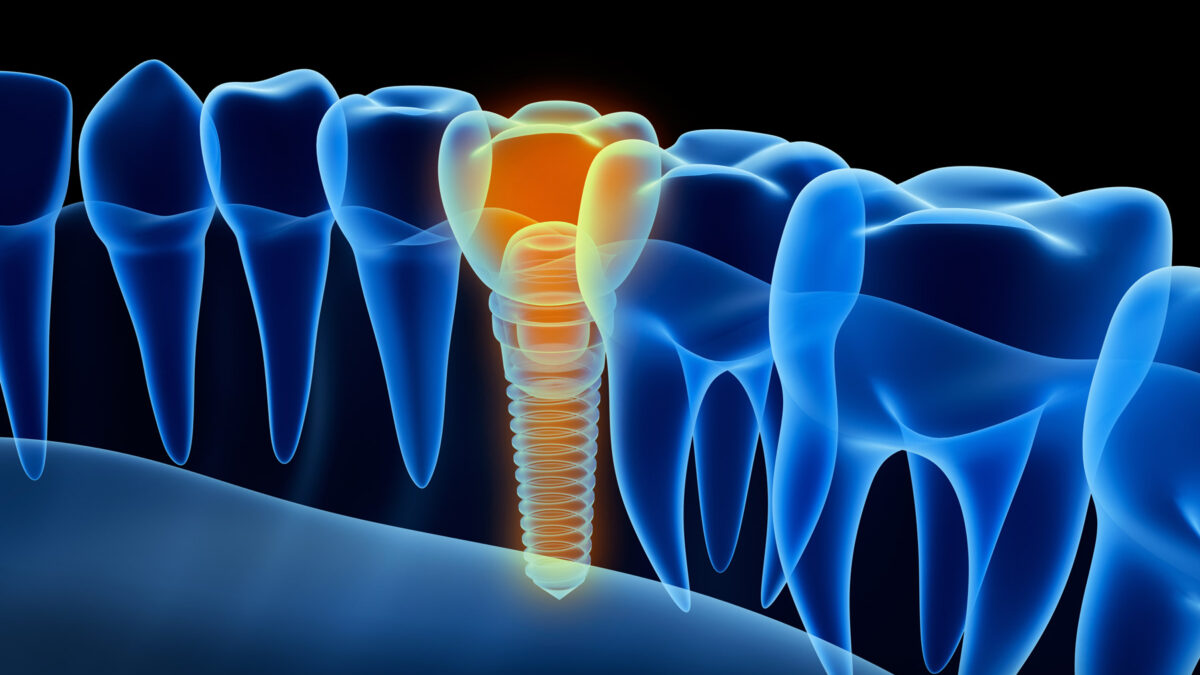 abstract image of dental implant between natural teeth