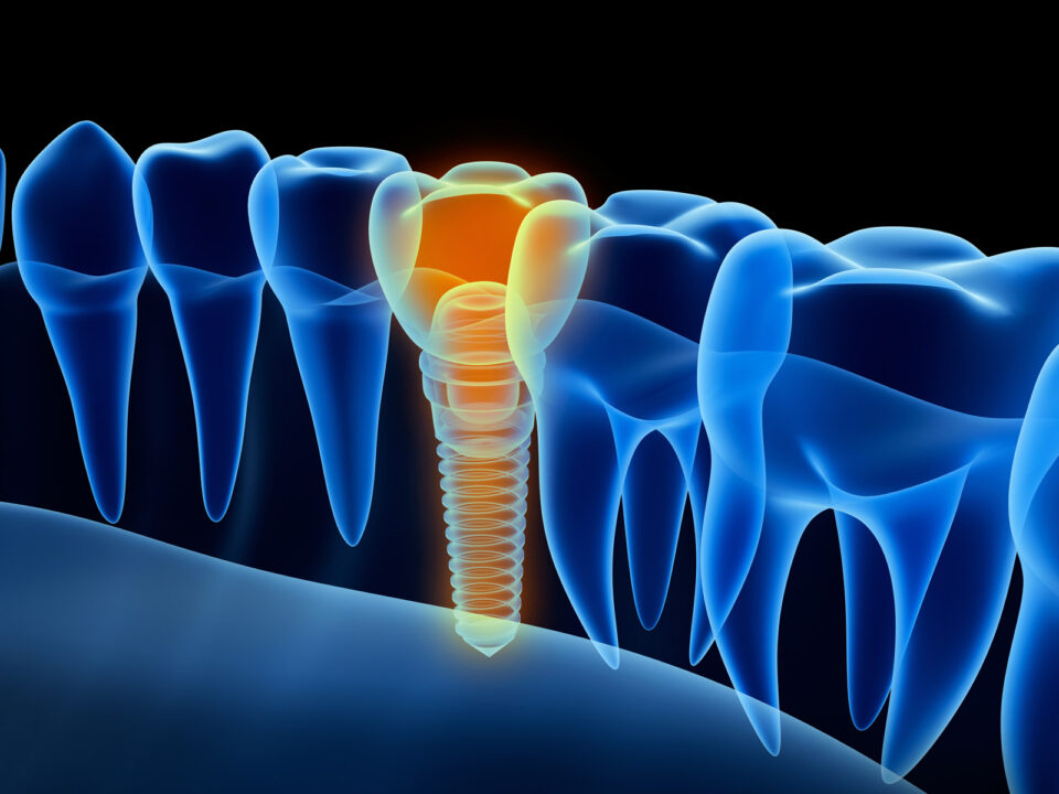 abstract image of dental implant between natural teeth
