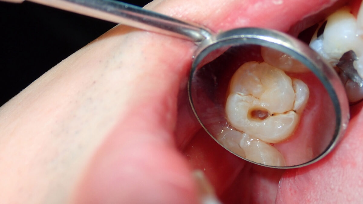 dental cavities in dentist mirror