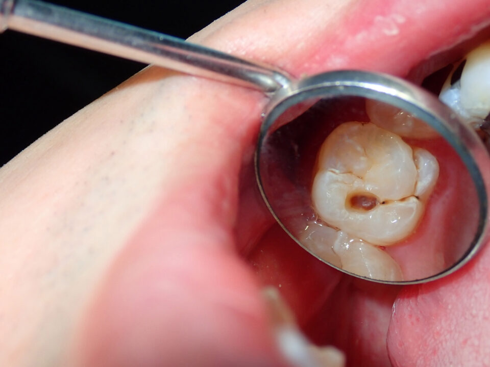 dental cavities in dentist mirror