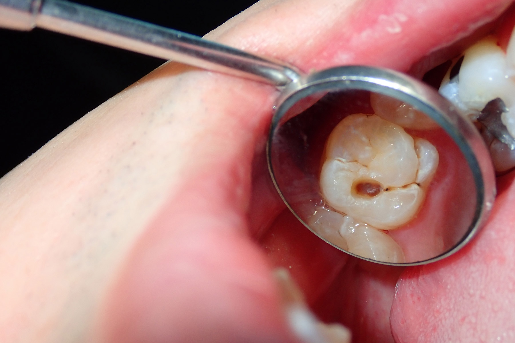 dental cavities in dentist mirror