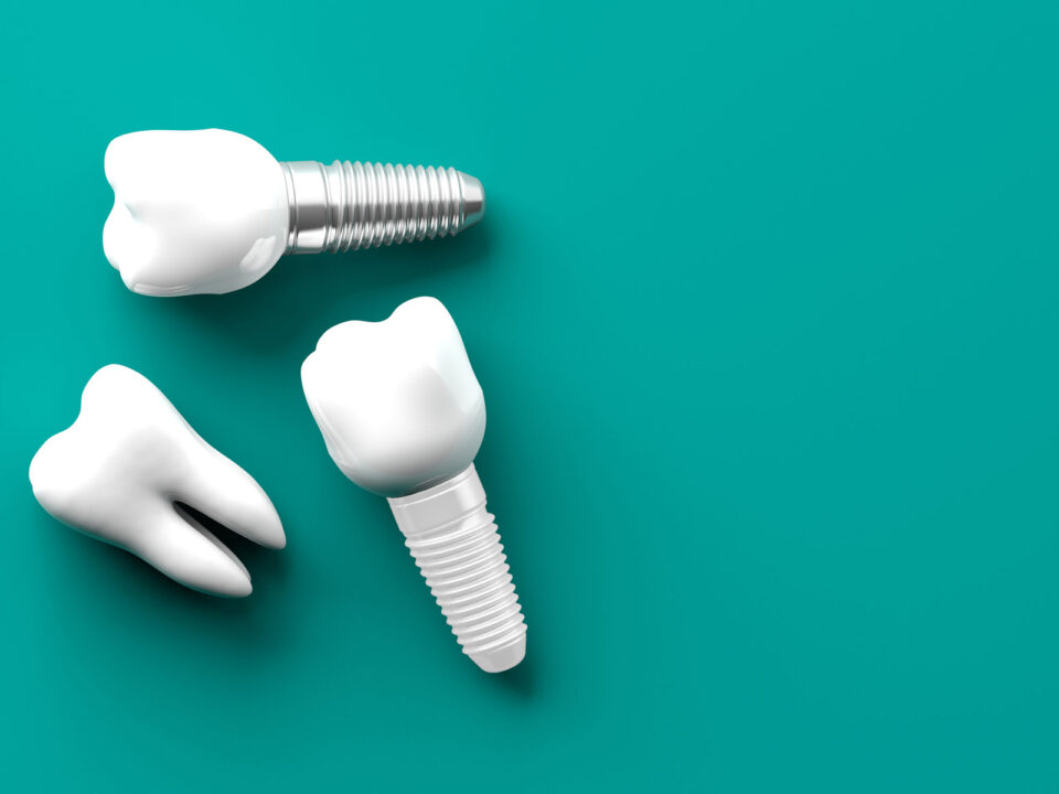 two dental Implants and one natural tooth in a frame