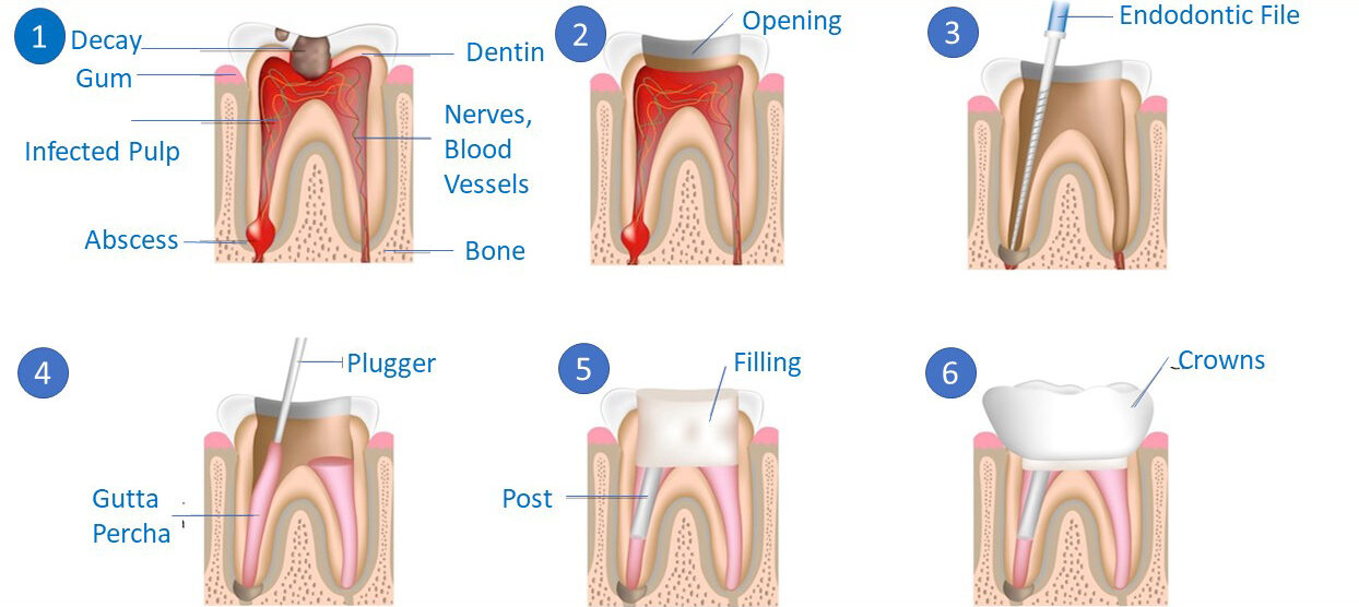 Alternatives to Root Canal Therapy