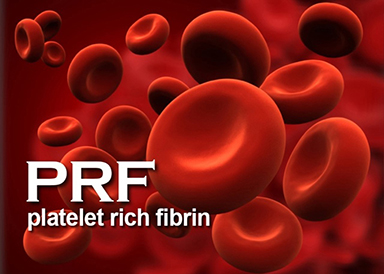 PRF platelet rich fibrin