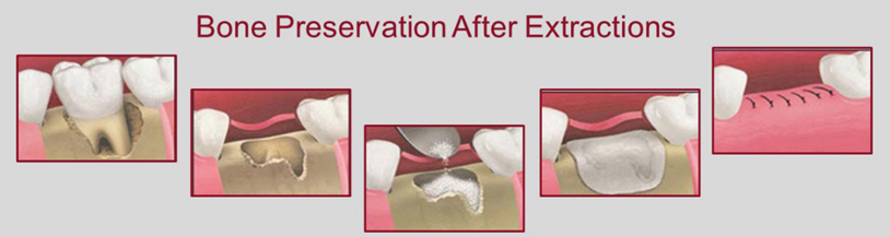 Bone Preservation after Extraction procedure