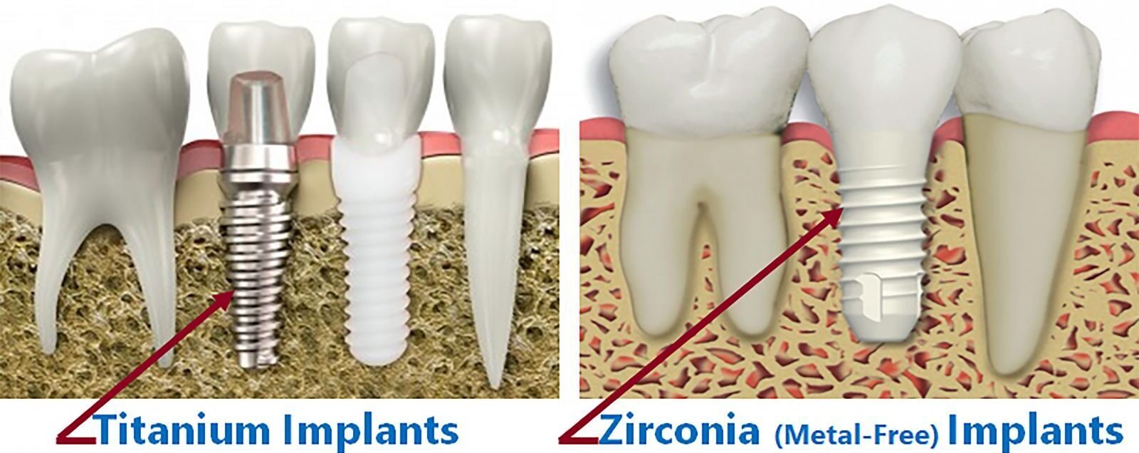 Zirconia and Titanium Implants comparison