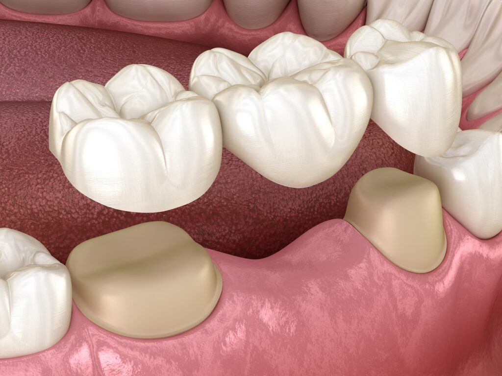 Dental Bridge 3D illustratioin
