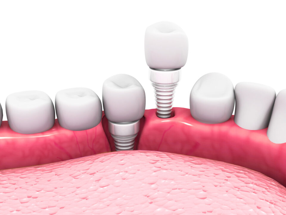 The Advantages of Ceramic Dental Implants