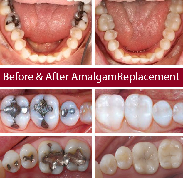 before and after of amalgam Replacement
