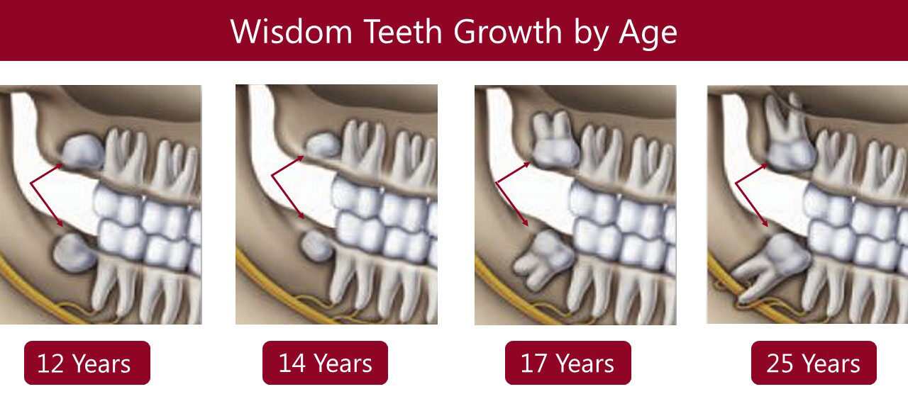 Wisdom Teeth Extractions