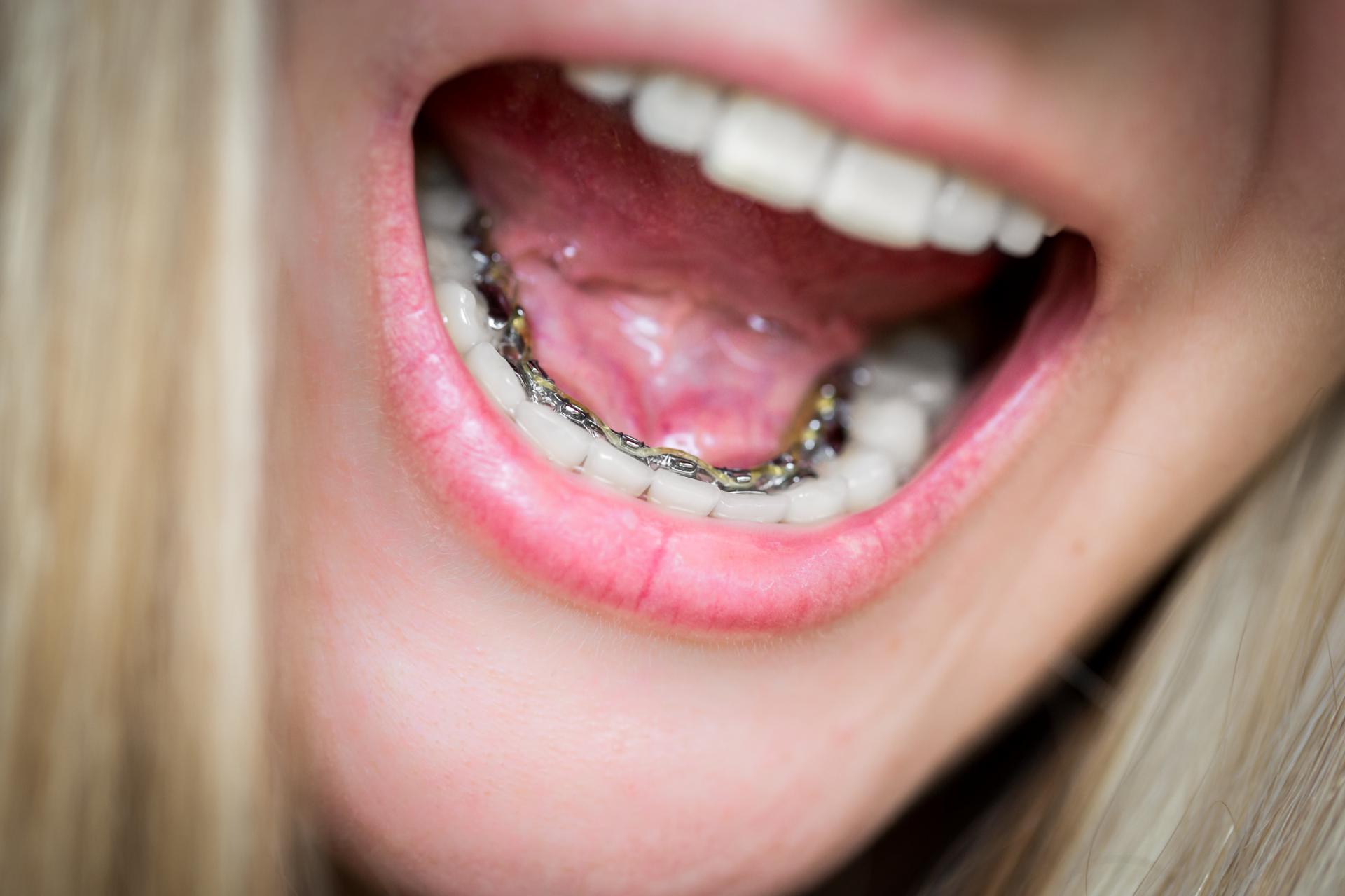 young woman with Orthodontics