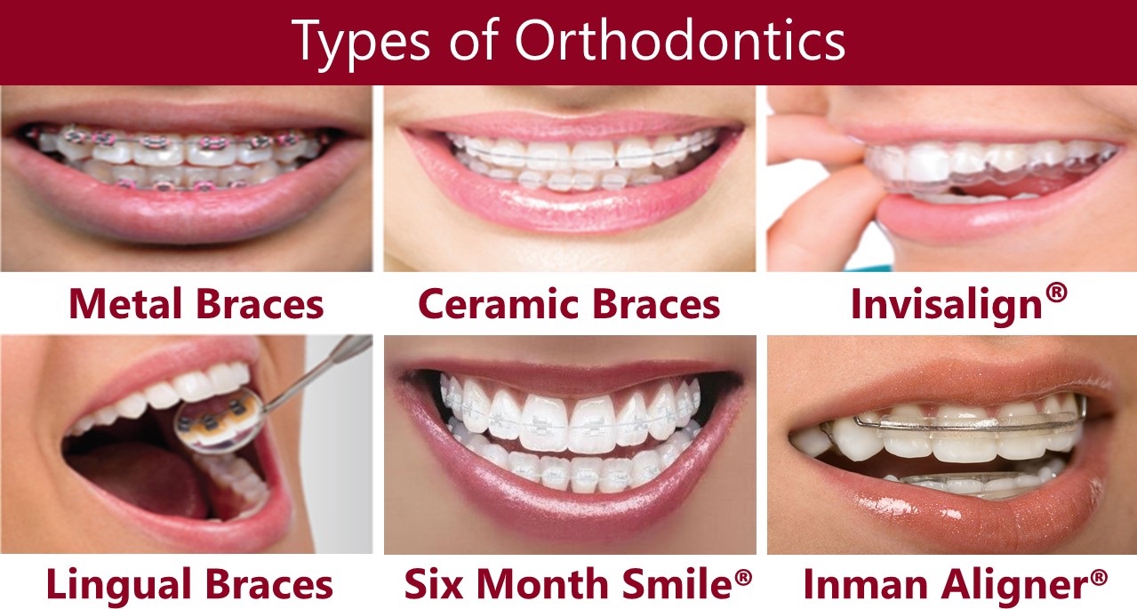 types of orthodontics