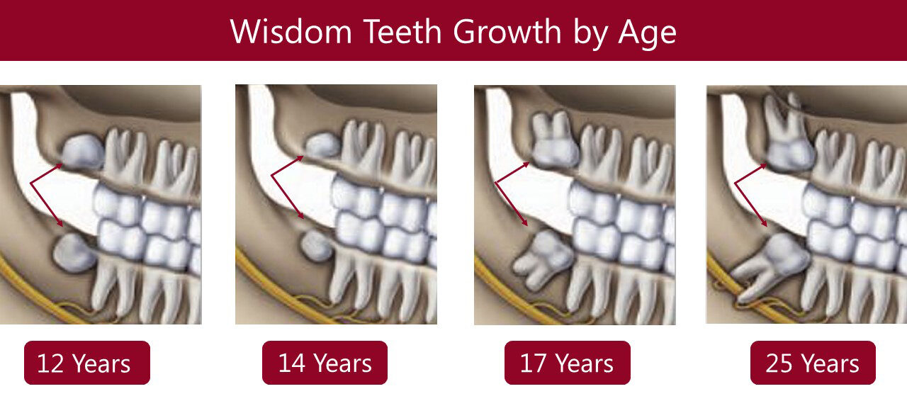 Wisdom Teeth growth in different ages
