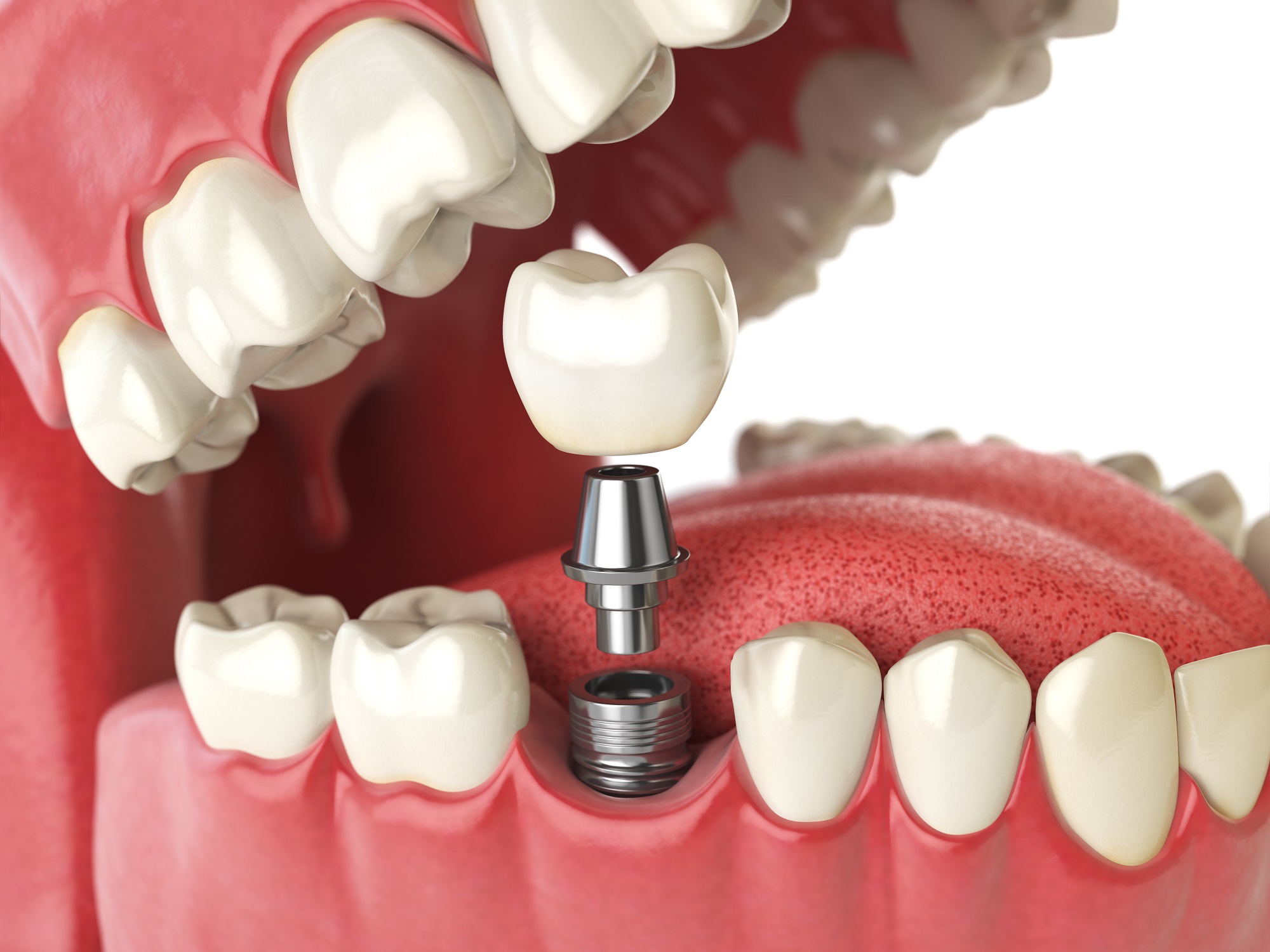 Tooth Implant 3D illustrations