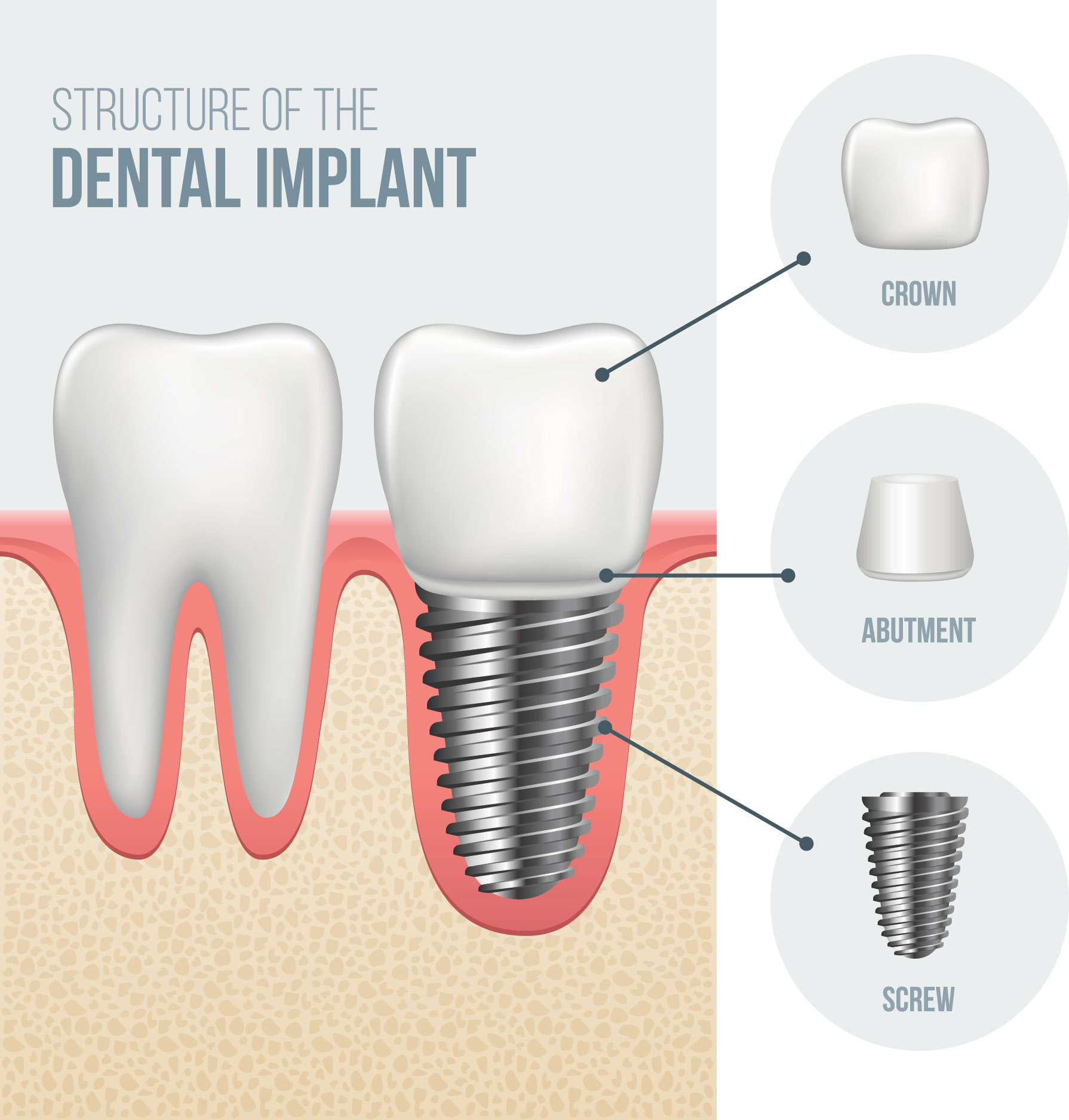 Dental Implants 3D illustration in comparison with natural tooth