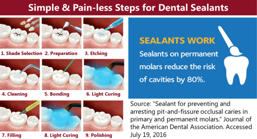 simple and pain-less steps for dental sealants digital illustrations