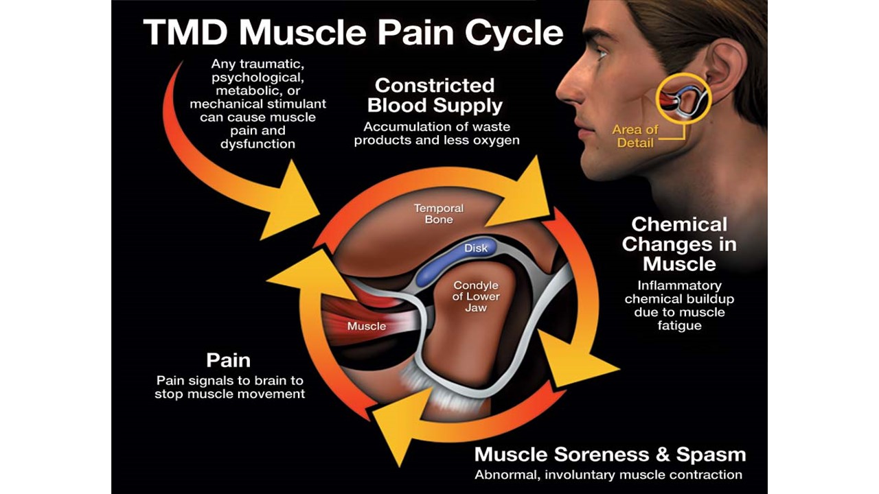 TMD Muscle Pain Cycle