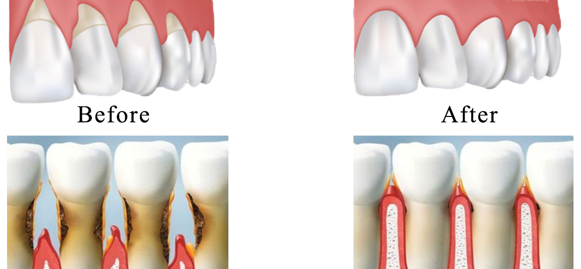 Gum-Grafting before after