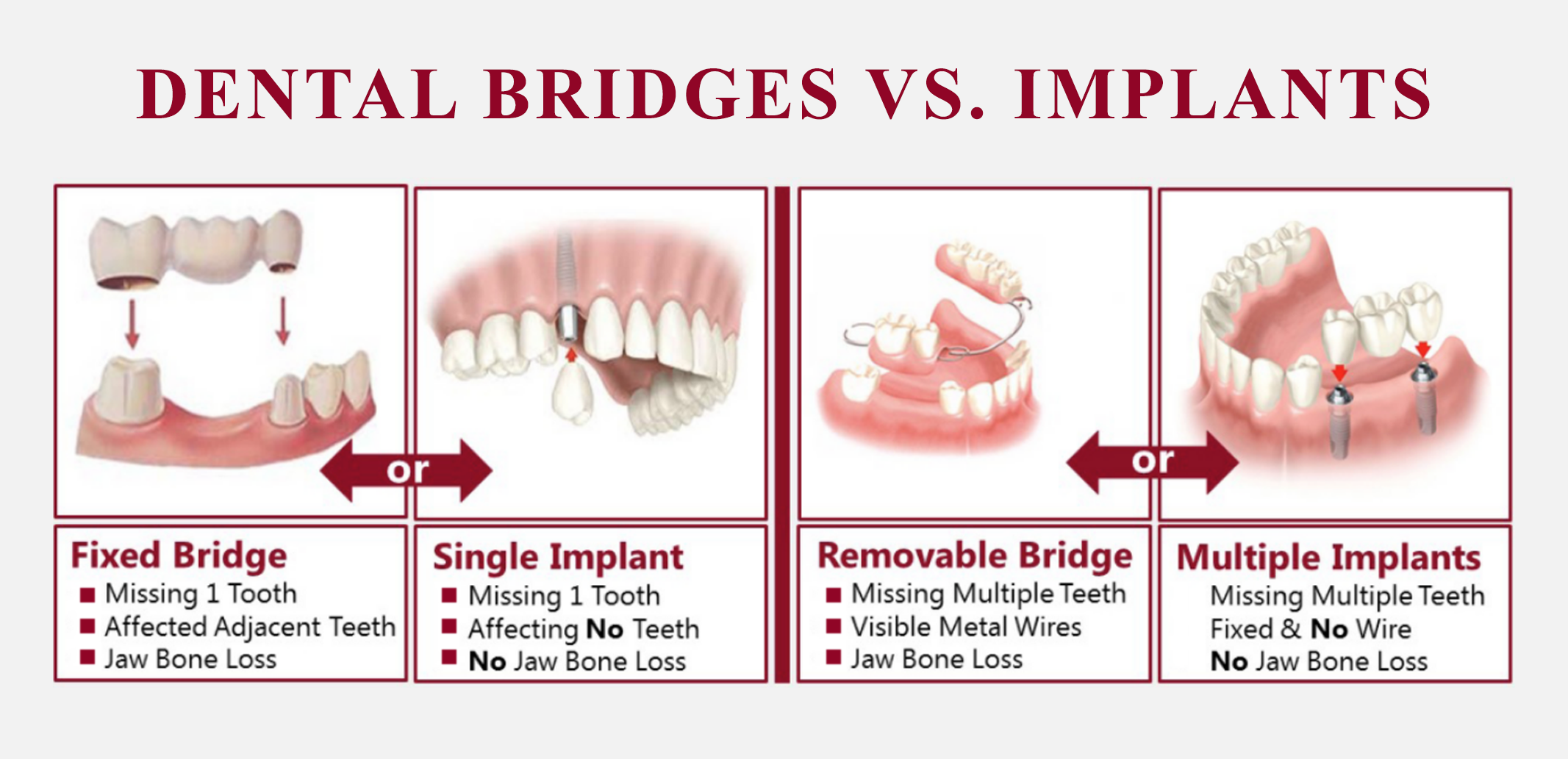 Dental Briges Vs. Implants