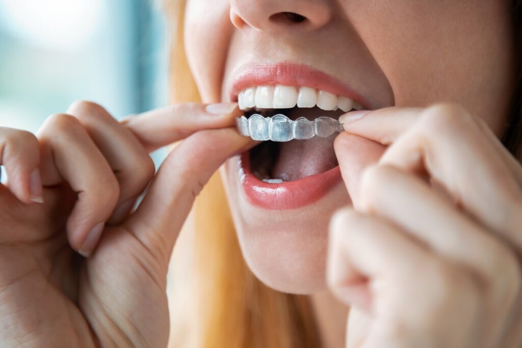 How does invisalign work