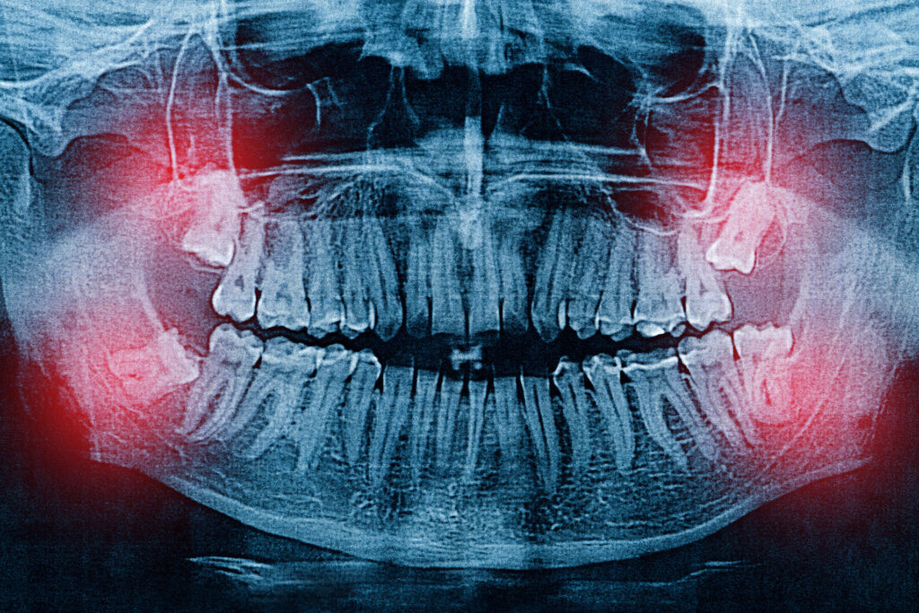 Teeth Extractions Will Leave No More Tooth Marks On Your American Heart In 2022