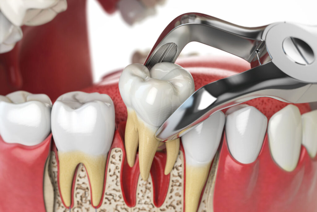 Teeth Extractions Will Leave No More Tooth Marks On Your American Heart In 2022