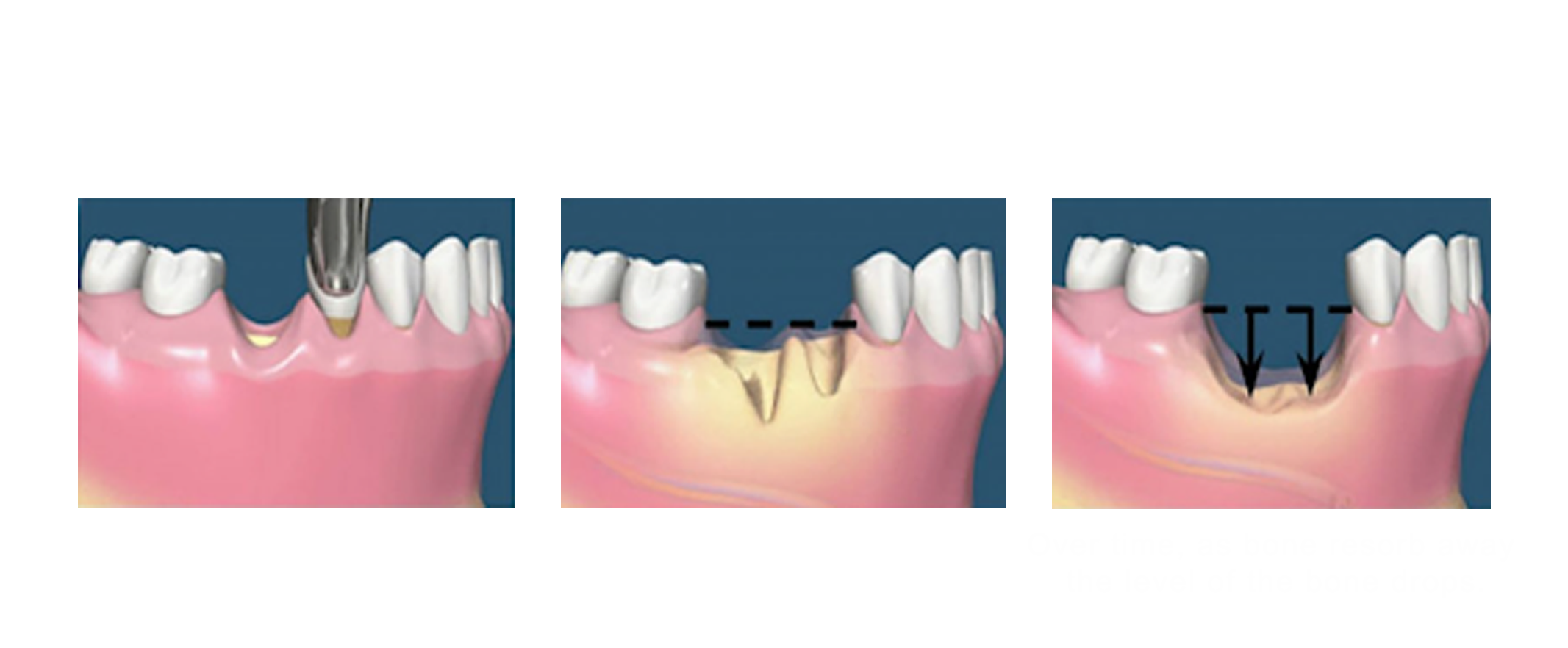 dental implant and bone resorption 3D illustration
