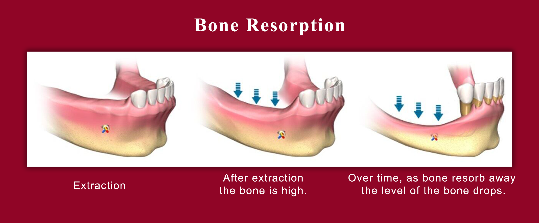 Bone Resorption stages