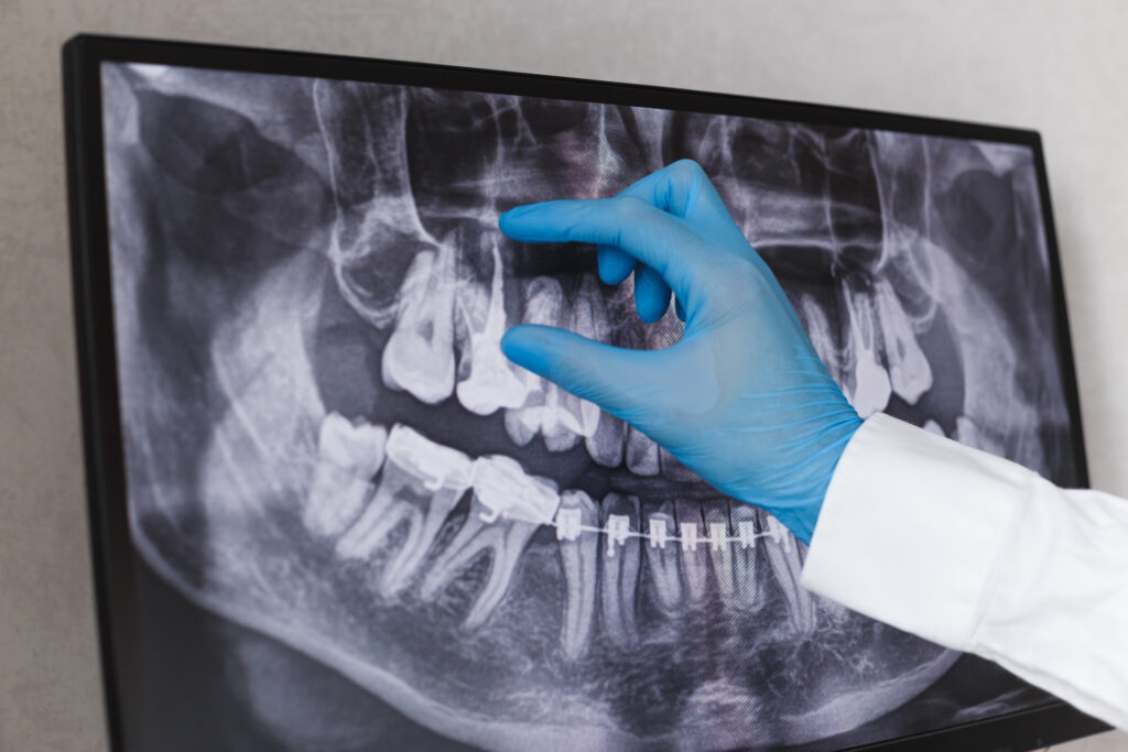 Smile Up To Date in Good Hands of Computer-Guided Implant Surgery