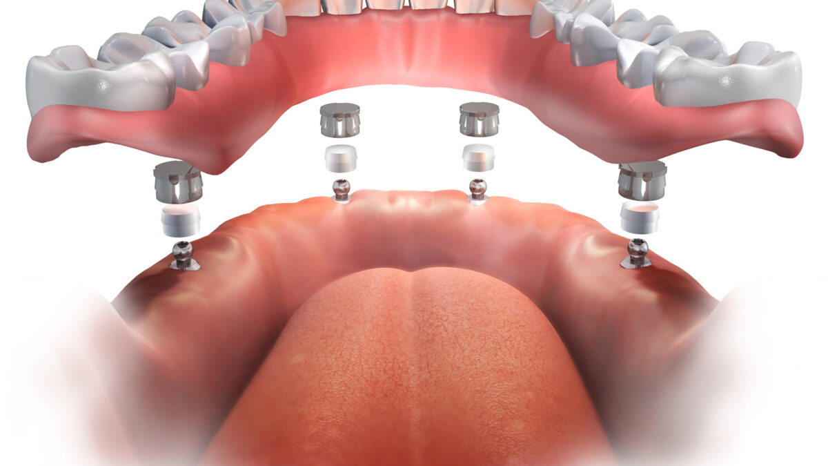 Attractiveness, Health, Self-esteem, and Intimacy, All On 4 Implants For The Spring Of Your Smile in 2022