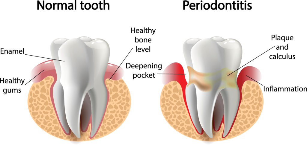 LANAP, A 1990 Godsend For Earth to Survive Gum Diseases