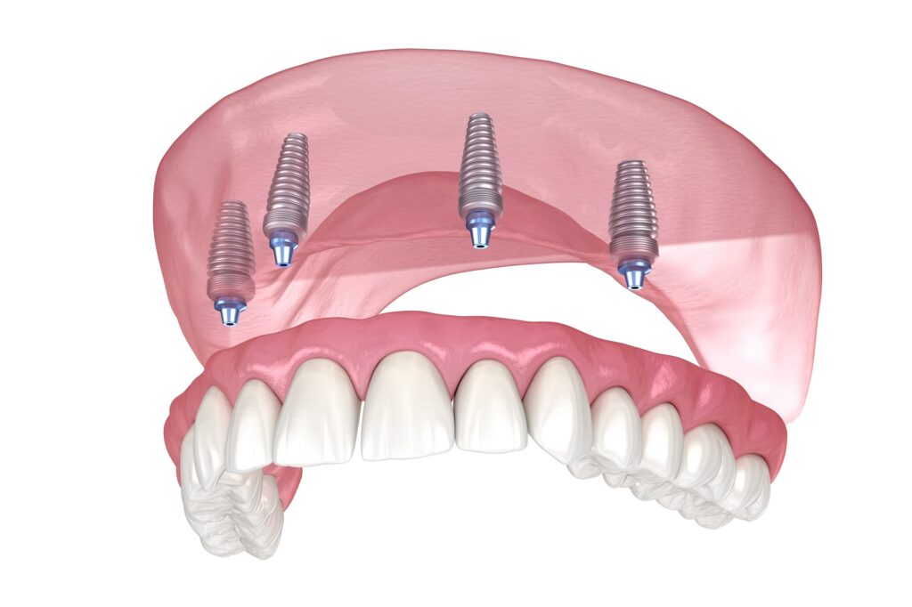 Attractiveness, Health, Self-esteem, and Intimacy, All On 4 Implants For The Spring Of Your Smile in 2022
