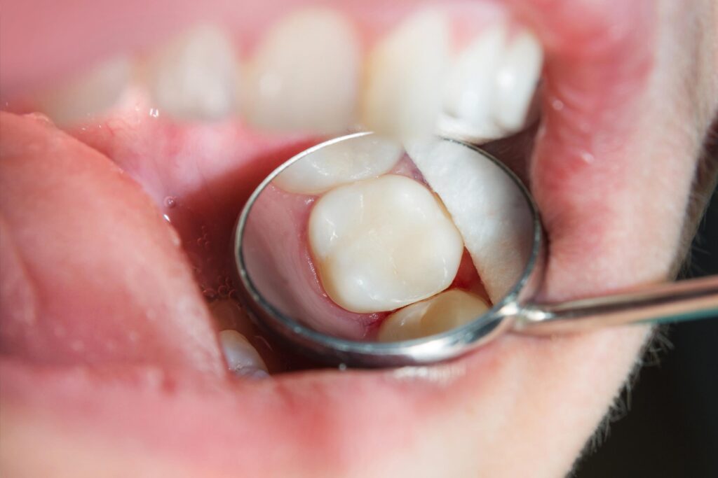 Act Smart with Silver Mercury; Your Smile Will Not Hurt Anymore!