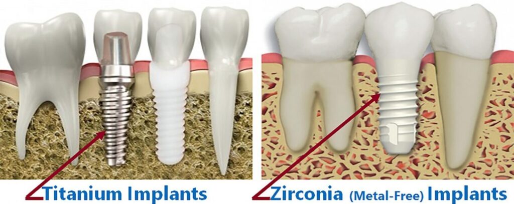 Why Choose Zirconia Implants?