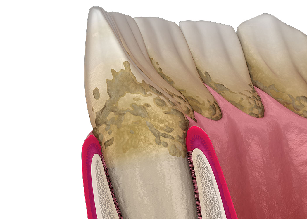 3D illustration of decade teeth