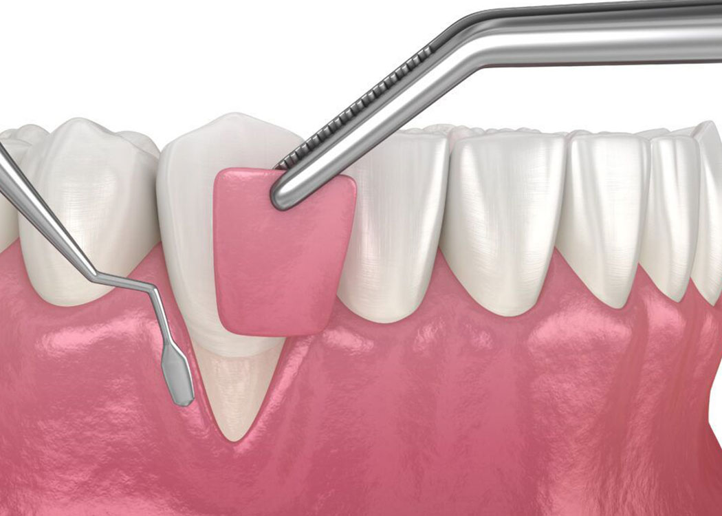 gum surgery 3D illustration