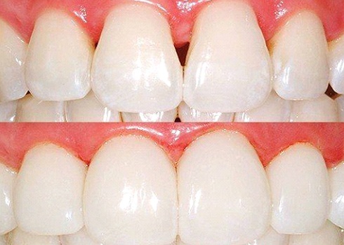 images of normal teeth and teeth with gap in between