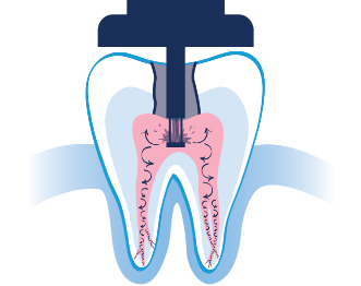 Root Canal Could Be A Thing of the Past with These Five Holistic Alternatives!