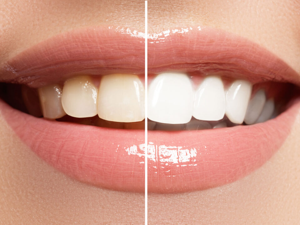 How to Whiten Teeth Safely: What Dentists Recommend 2 How to Whiten Teeth Safely: What Dentists Recommend