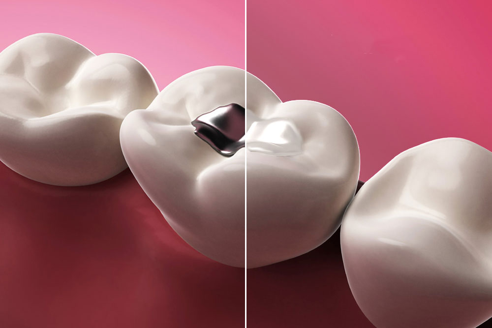 comparison between metal free dental filling and mercury amalgam
