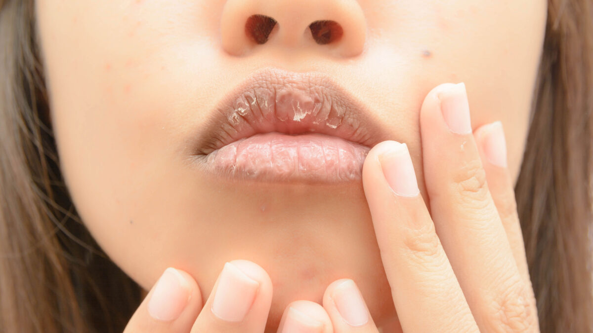 Dry Mouth Is Common but Still Irritating
