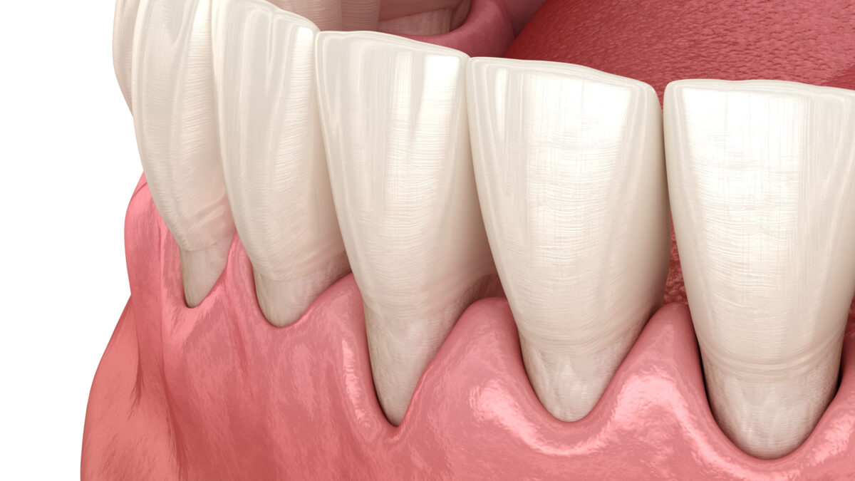 Gum Recession: When Your Gums Take Revenge On You for Aggressive Teeth Cleaning