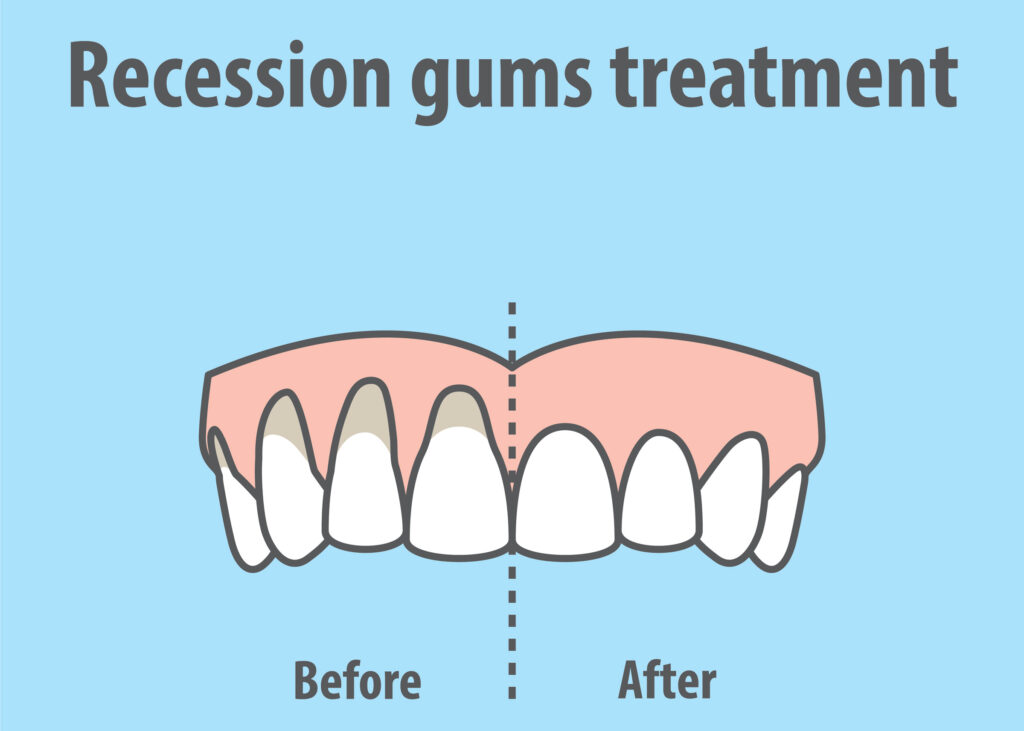 Gum Recession: When Your Gums Take Revenge On You for Aggressive Teeth Cleaning