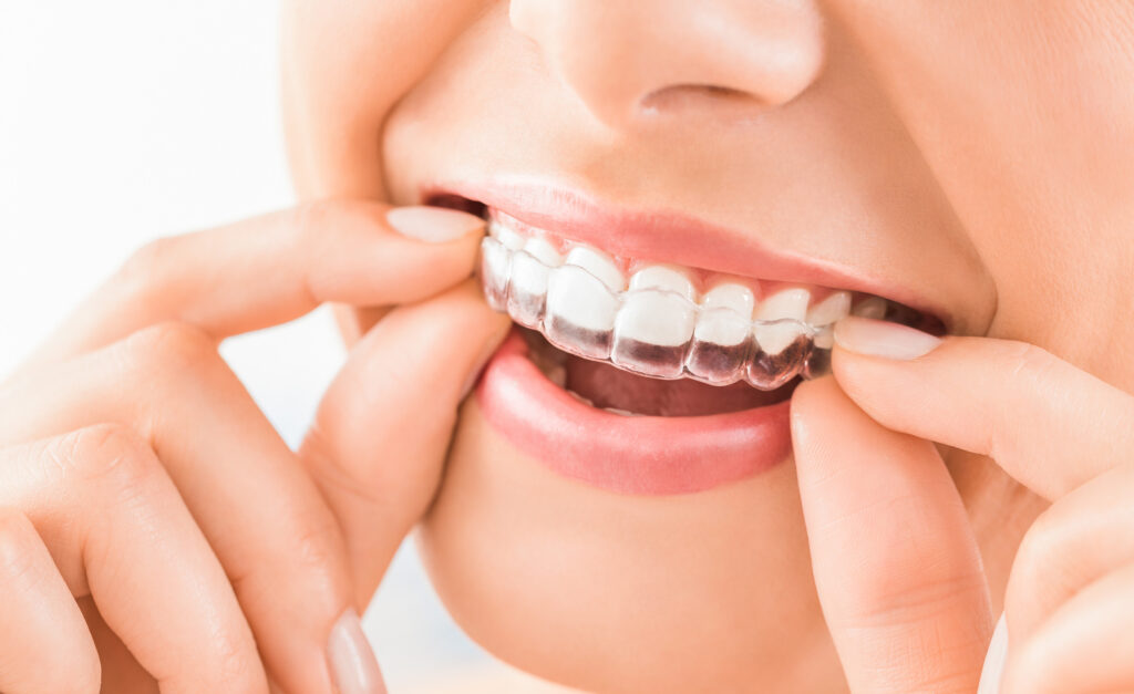 Things You Should Know About Invisalign for Teens